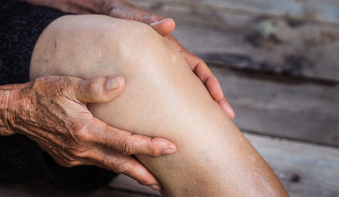 Natural Remedies for Osteoarthritis