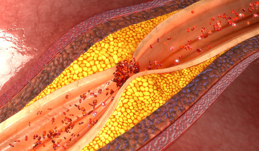 Can Your Good Cholesterol Go Bad?